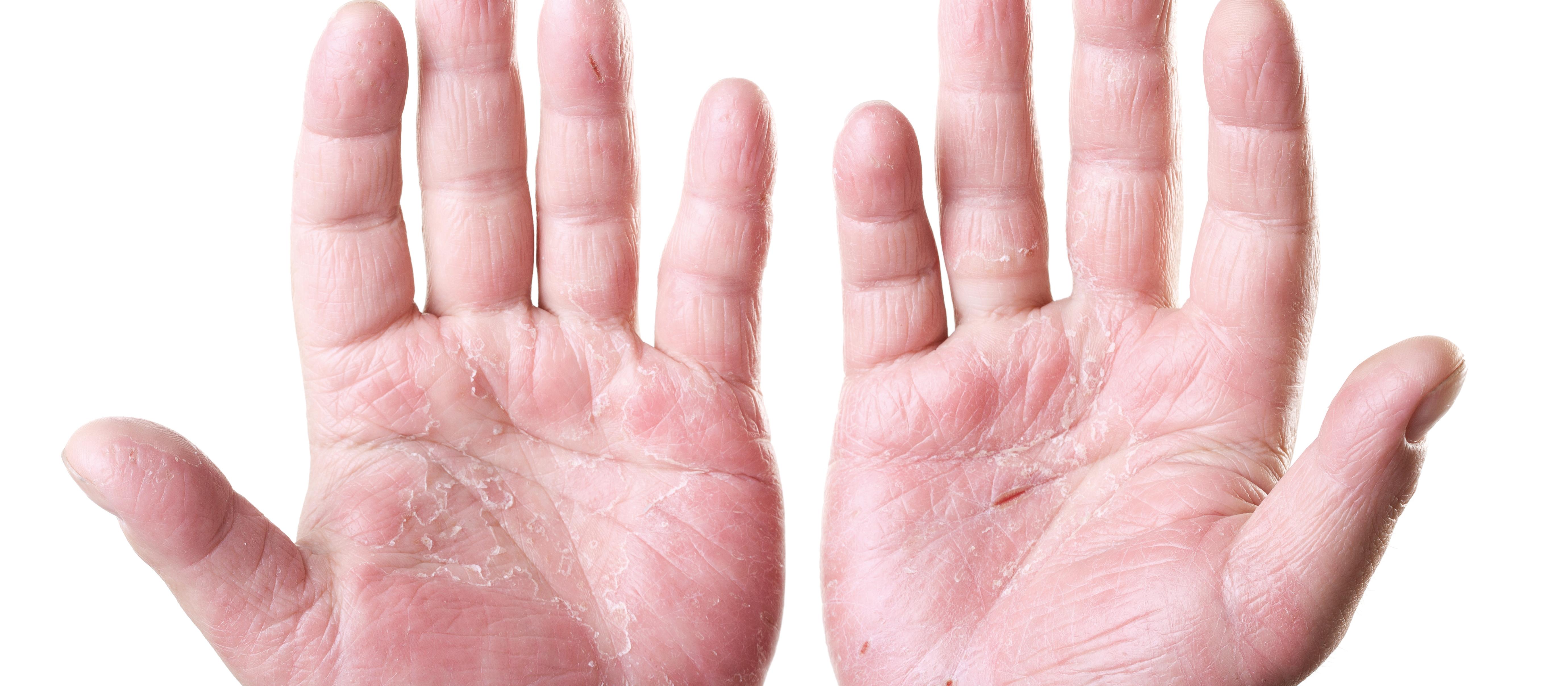 Eczema hands